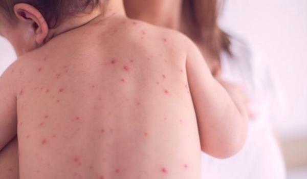 Улаанбурхан өвчин нууц хугацааны 3-5 хоногтоо вирус цусаар дамжина