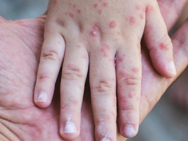 Улаанбурхан өвчний батлагдсан тохиолдол 24 болжээ