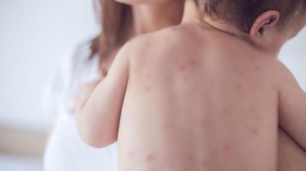 Улаанбурхан өвчний 55 тохиолдол бүртгэгдээд байна