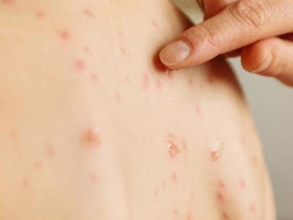 ХӨСҮТ: Улаанбурхан өвчний батлагдсан тохиолдол 220 болжээ