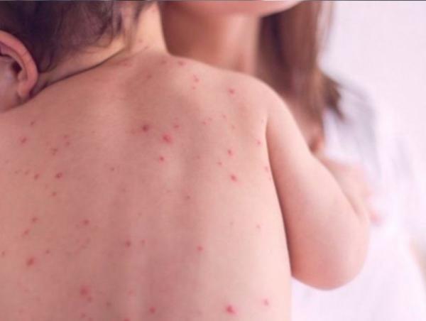 ХӨСҮТ: Улаанбурхан өвчний батлагдсан тохиолдол 328 боллоо