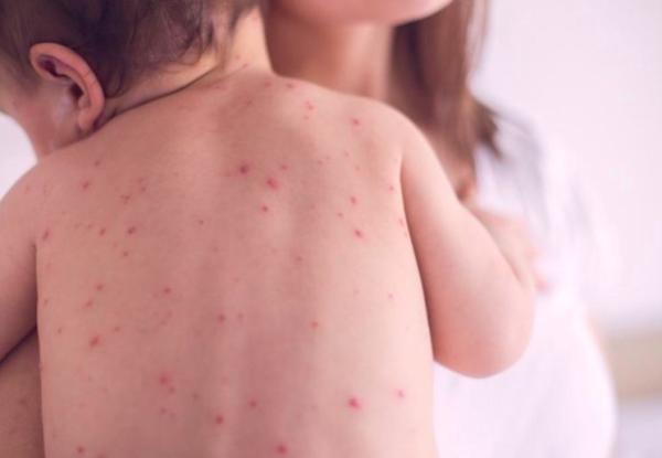 ХӨСҮТ: Улаанбурхан өвчний 659 тохиолдол бүртгэгдлээ
