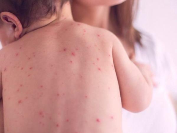 ХӨСҮТ: Улаанбурхан өвчний лабораториор батлагдсан 1360 болжээ